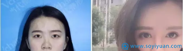 重庆当代黄鲜阿尔法美眼案例 重庆当代黄鲜阿尔法美眼案例