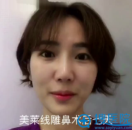 美莱线雕隆鼻术后7天效果 美莱线雕隆鼻术后7天效果