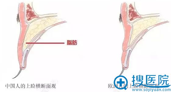 为什么割完双眼皮后会有肉条感示意图 为什么割完双眼皮后会有肉条感示意图