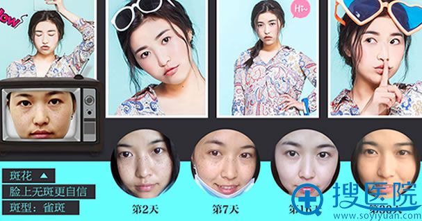 重庆华美光魔动力祛斑案例效果图 重庆华美光魔动力祛斑案例效果图