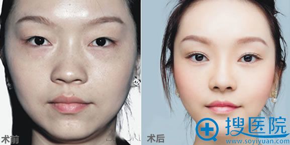 深圳美莱双眼皮案例 深圳美莱双眼皮案例