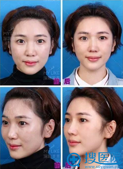 深圳美莱线雕隆鼻前后对比图 深圳美莱线雕隆鼻前后对比图