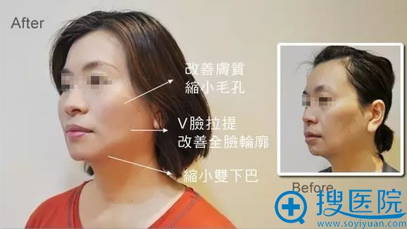 面部线雕提升术真人案例 面部线雕提升术真人案例