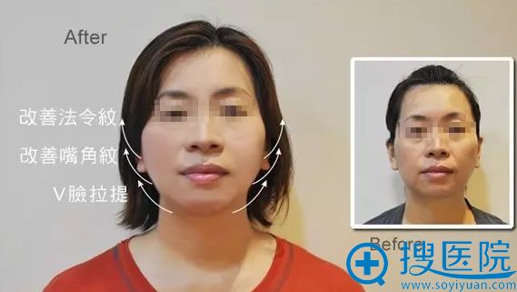 面部线雕提升术真人案例 面部线雕提升术真人案例