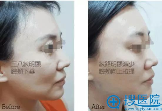 面部线雕提升术前后对比案例 面部线雕提升术前后对比案例