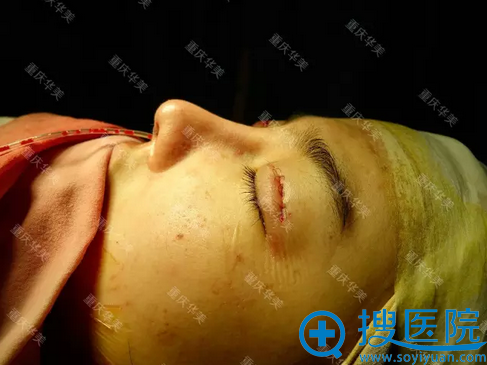 术后即刻效果 术后即刻效果