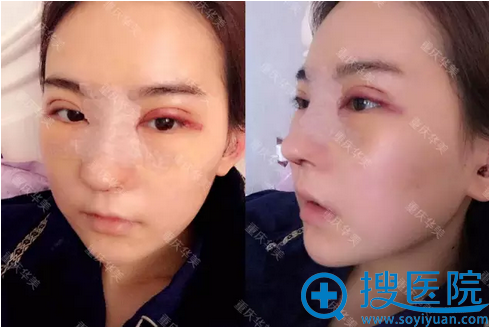 隆鼻+双眼皮术后第三天,有点肿 隆鼻+双眼皮术后第三天,有点肿
