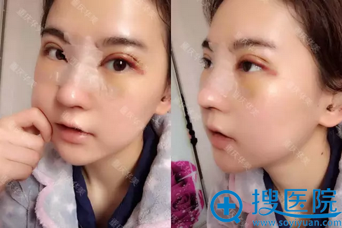 术后第5天.面部都有立体感了 术后第5天.面部都有立体感了