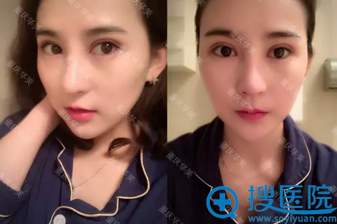 术后两周了,恢复的非常好 术后两周了,恢复的非常好