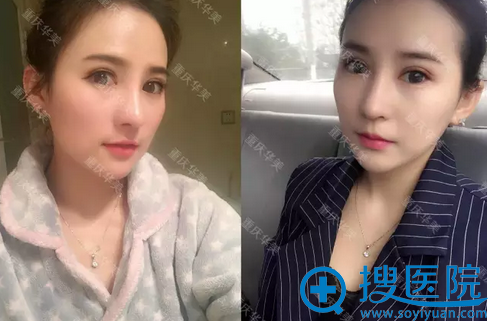 术后23天,超自然有木有 术后23天,超自然有木有