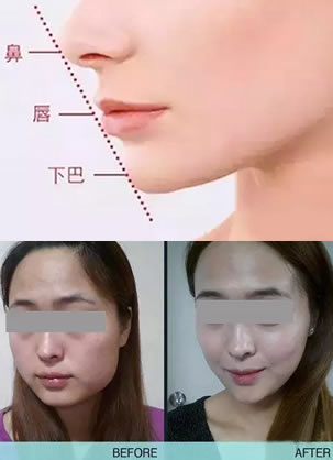 和玻尿酸同时打效果太惊人啦 上海华美真人案例见证效果