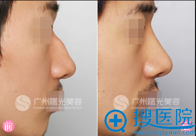 广州曙光刘志伟隆鼻案例 广州曙光刘志伟隆鼻案例