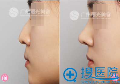 广州曙光整形医院刘志伟隆鼻案例 广州曙光整形医院刘志伟隆鼻案例