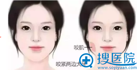 鉴定咬肌的方法 鉴定咬肌的方法