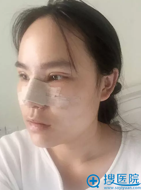 达拉斯鼻综合术后恢复效果 达拉斯鼻综合术后恢复效果