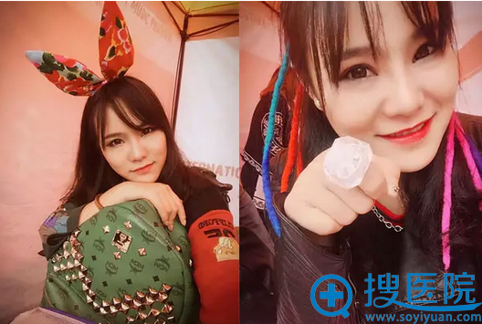 术后自拍 美鼻翘起来 术后自拍 美鼻翘起来