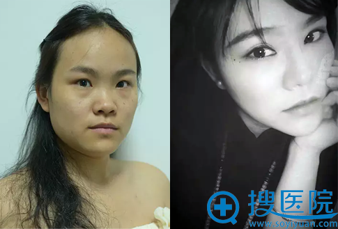 达拉斯鼻综合+双眼皮术前术后对比照 达拉斯鼻综合+双眼皮术前术后对比照