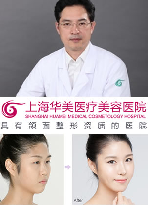 去上海华美找李庭勋做鼻综合整形一个月恢复过程