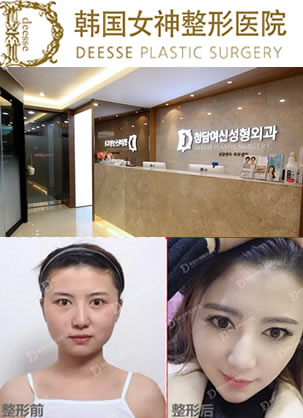 在韩国女神整形做颧弓内推+下颚角整形+假体隆下巴前后对比效果