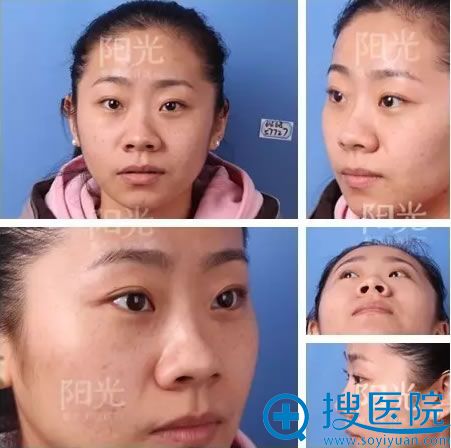 美人鱼隆鼻、丰下巴术前照片 美人鱼隆鼻、丰下巴术前照片