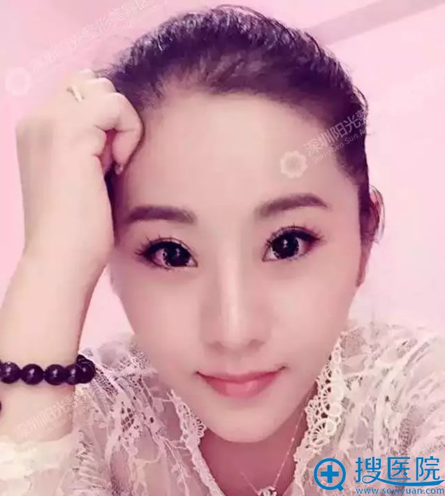 面部整形后美人鱼自拍照 面部整形后美人鱼自拍照