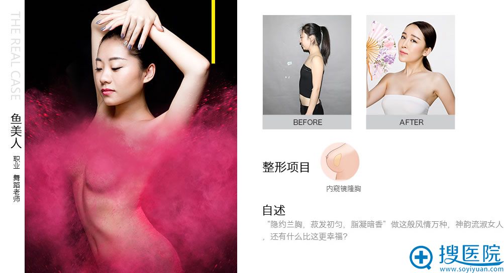 美人鱼丰胸前后对比 美人鱼丰胸前后对比