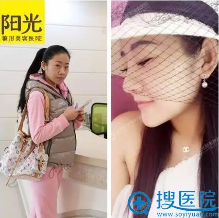 深圳阳光整形技术怎么样 面部整形、假体丰胸让她破茧成蝶