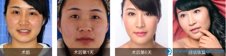 <!--<i data=20240710 data-id=14448></i>-->激光祛斑术后效果 <!--<i data=20240710 data-id=14448></i>-->激光祛斑术后效果