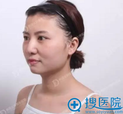 韩国女神整形医院做颧弓内推+下颚角整形术前照 韩国女神整形医院做颧弓内推+下颚角整形术前照