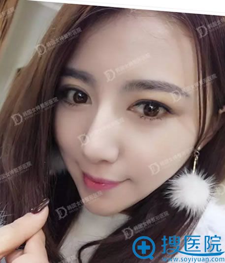 做颧弓内推+下颚角整形+假体隆下巴一年后效果 做颧弓内推+下颚角整形+假体隆下巴一年后效果