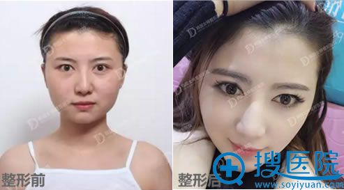 在韩国女神整形做颧弓内推+下颚角整形+假体隆下巴前后对比效果 在韩国女神整形做颧弓内推+下颚角整形+假体隆下巴前后对比效果