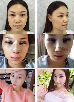 昆明韩辰整形医院做肋软骨隆鼻+鼻翼缩小32980元,看效果如何