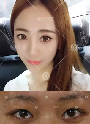 贵阳华美做双眼皮好吗?单眼皮肿泡眼丑女大翻身效果用图说话