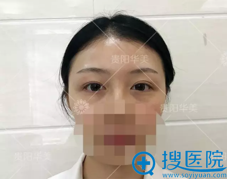 术前素颜照 术前素颜照