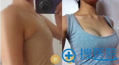 唐山金荣_脂肪丰胸案例 唐山金荣_脂肪丰胸案例