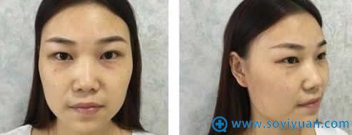 在韩辰做鼻子整形手术前照片 在韩辰做鼻子整形手术前照片