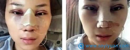 昆明韩辰做完隆鼻和鼻翼缩小手术照片 昆明韩辰做完隆鼻和鼻翼缩小手术照片