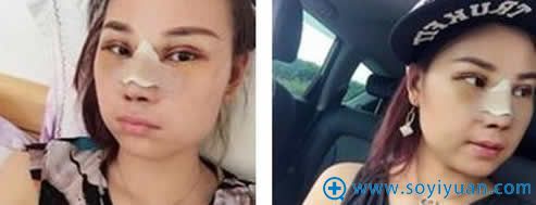 做完鼻综合整形手术第4天_昆明韩辰整形 做完鼻综合整形手术第4天_昆明韩辰整形