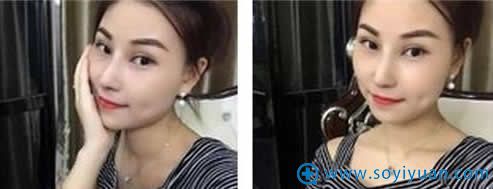 昆明韩辰整形医院鼻综合整形案例 昆明韩辰整形医院鼻综合整形案例