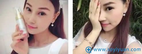 昆明韩辰胡乔做完鼻综合20天照片 昆明韩辰胡乔做完鼻综合20天照片