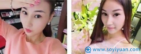 在昆明韩辰做完鼻子手术一个月 在昆明韩辰做完鼻子手术一个月