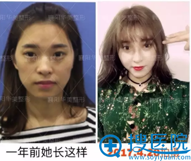 【真人案例】襄阳华美整形医院13000元全脸自体脂肪填充心形脸