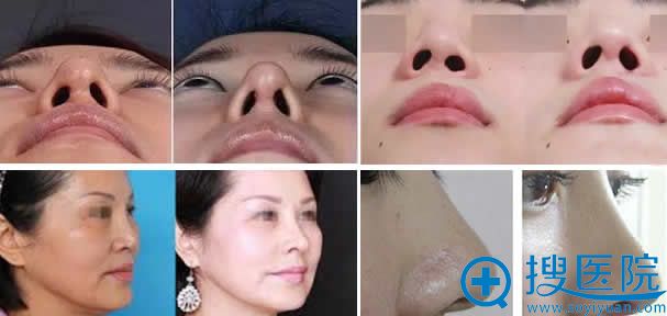 厦门华美鼻整形失败修复案例 厦门华美鼻整形失败修复案例