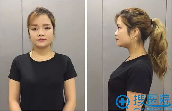 真实案例揭秘重庆铜雀台陶俊隆鼻好不好 硅胶隆鼻3999元