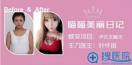 分享我的隆胸日记 分享我的隆胸日记