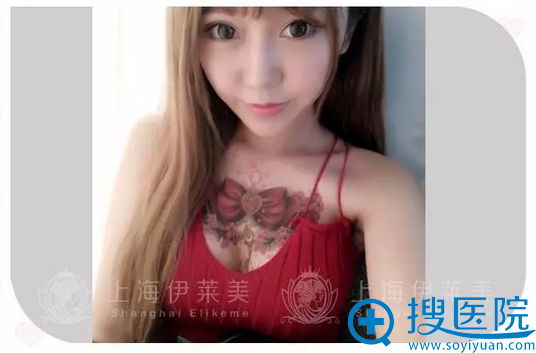 术后一个月手感很好哦 术后一个月手感很好哦
