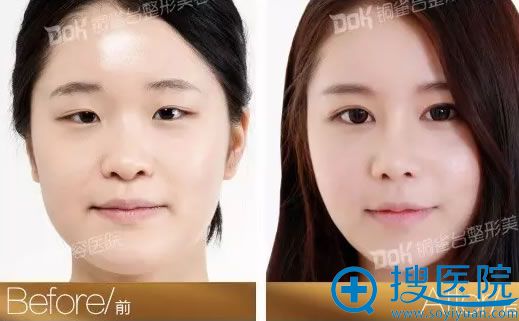 重庆铜雀台双眼皮前后效果对比图 重庆铜雀台双眼皮前后效果对比图