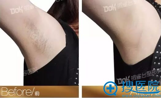 铜雀台脱腋毛前后对比 铜雀台脱腋毛前后对比