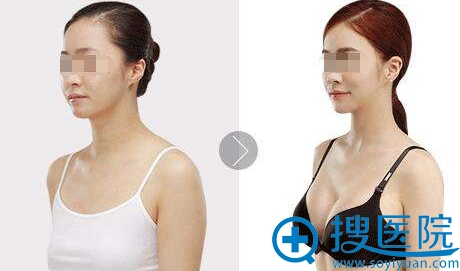 四川美莱自体脂肪丰胸效果对比照 四川美莱自体脂肪丰胸效果对比照