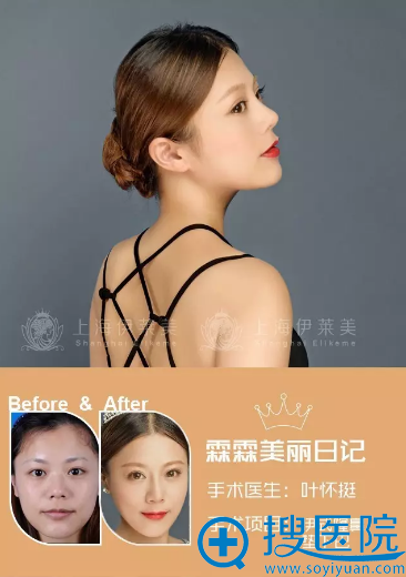 【隆鼻恢复日记】花5千元找上海伊莱美医院叶怀挺隆鼻1年啦